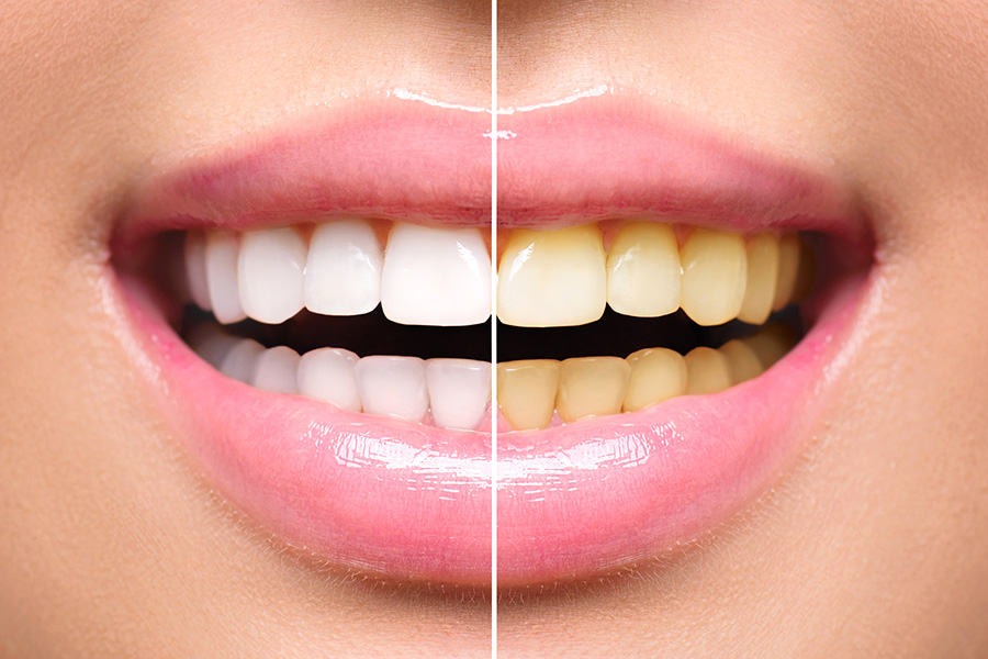 Hábitos que podem deixar os dentes amarelos | Andrade Odontologia